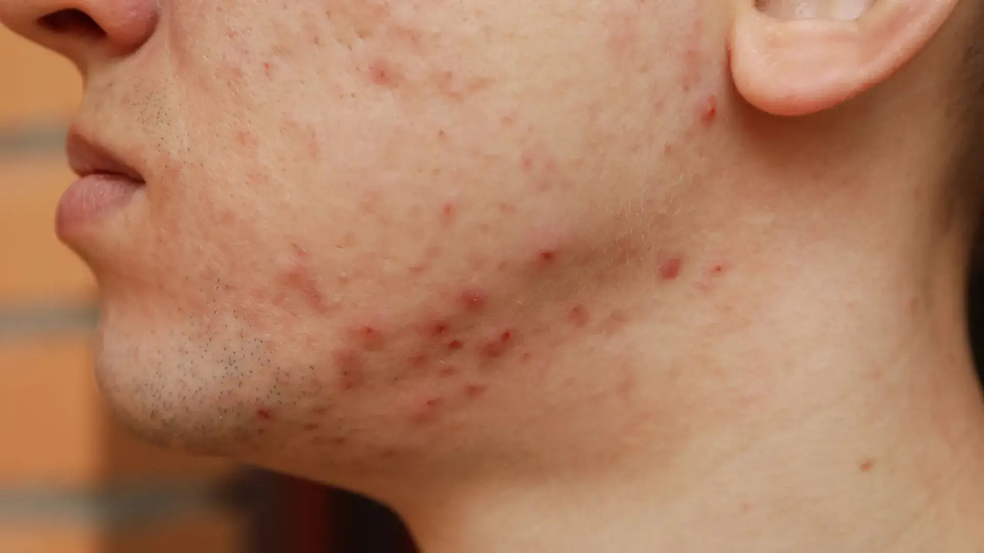 Acne