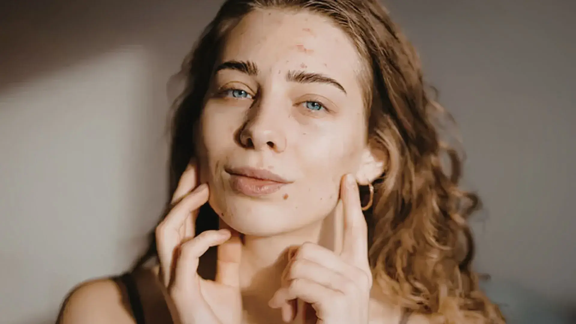 Different Forms of Acne