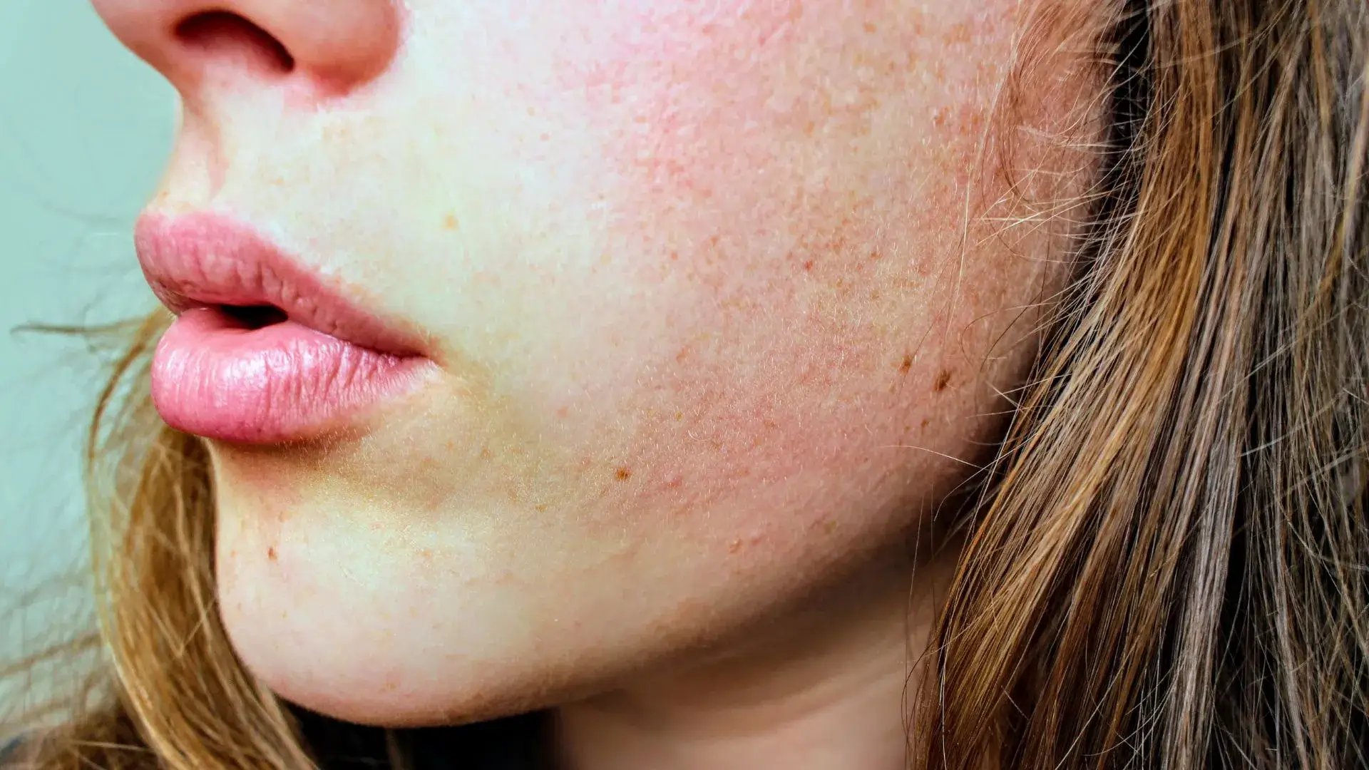 How Eczema Affects Your Skin and Body