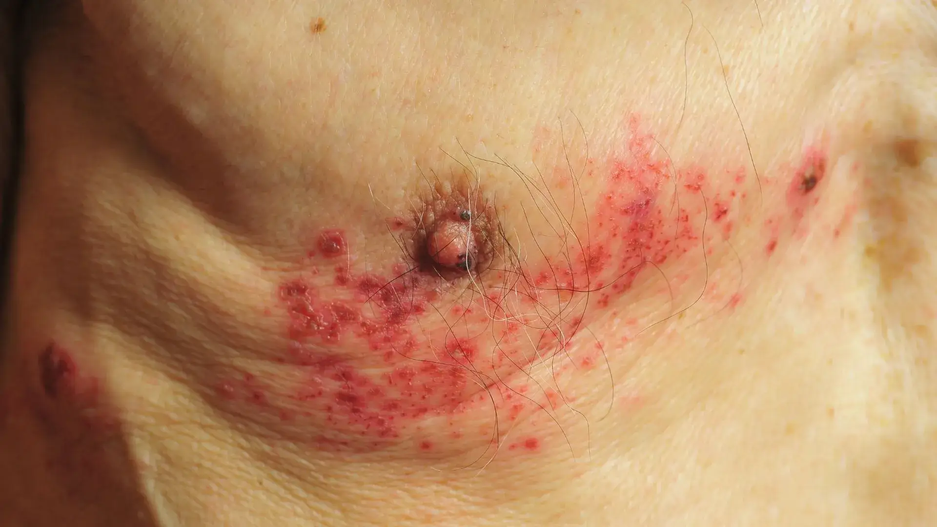 Common Causes and Risk Factors of Shingles + Post-Herpetic Neuralgia