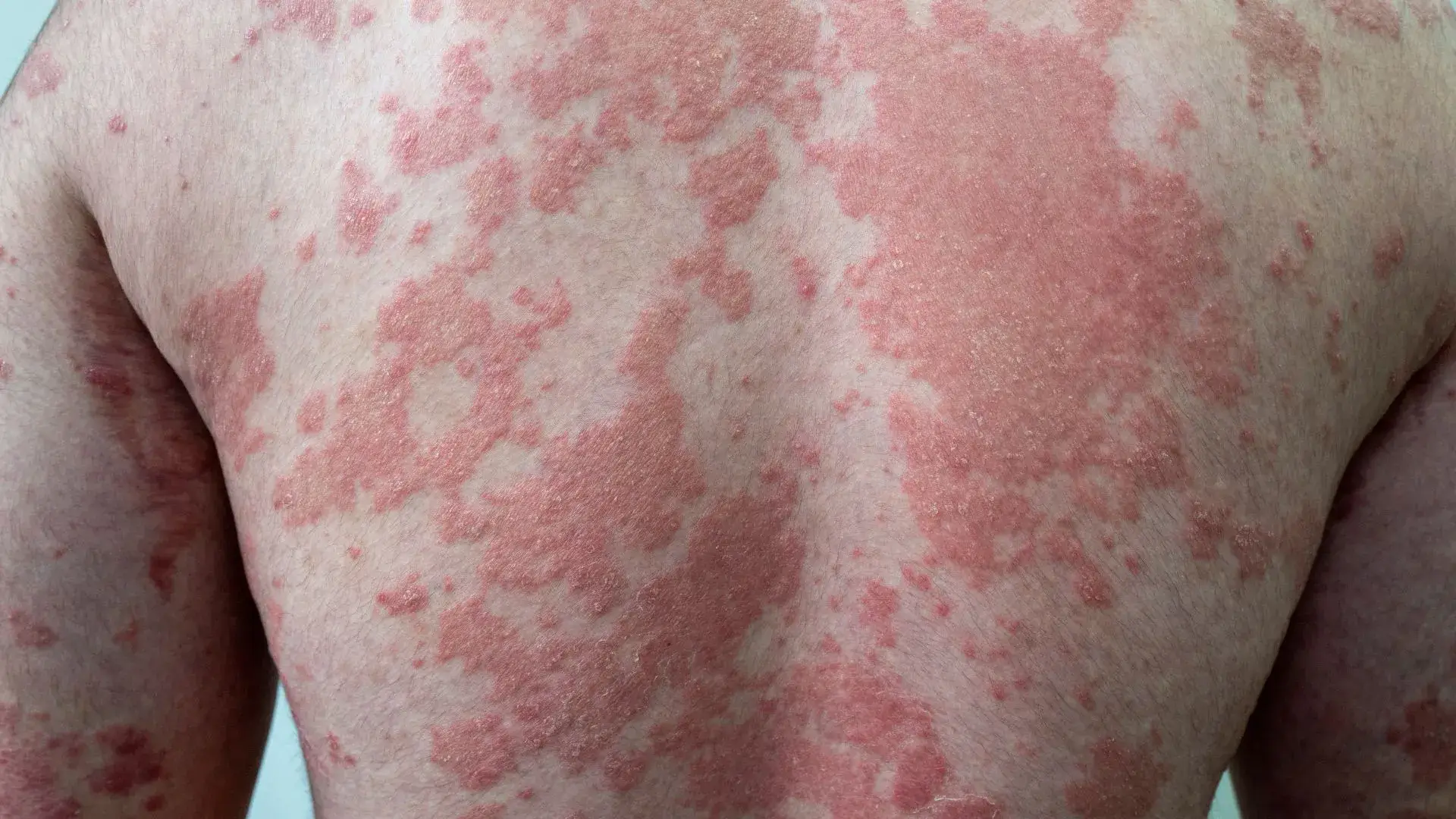 How Psoriasis Affects Your Body