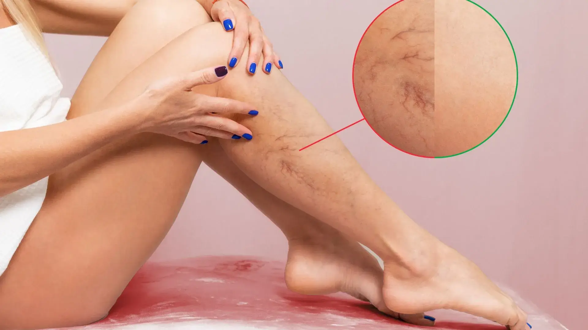 How Varicose Veins Affect Your Body