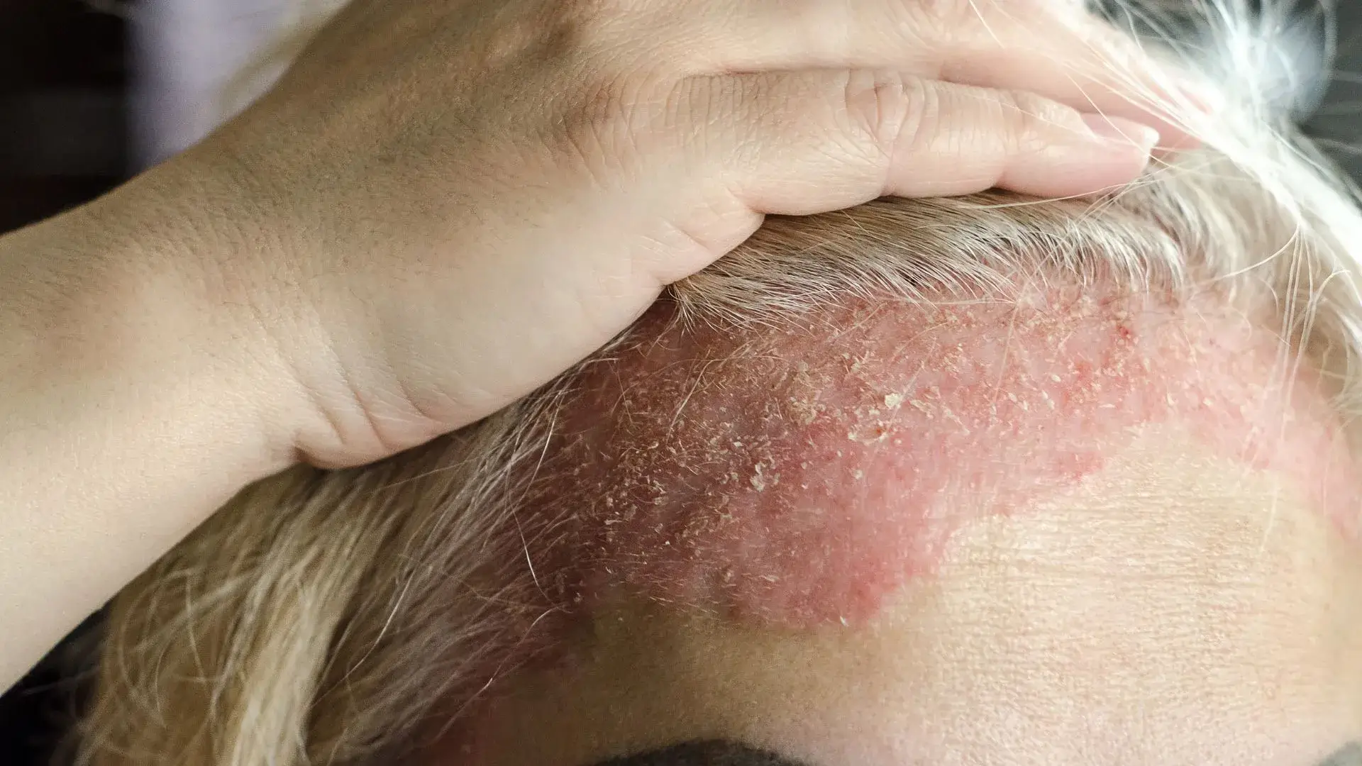 Psoriasis
