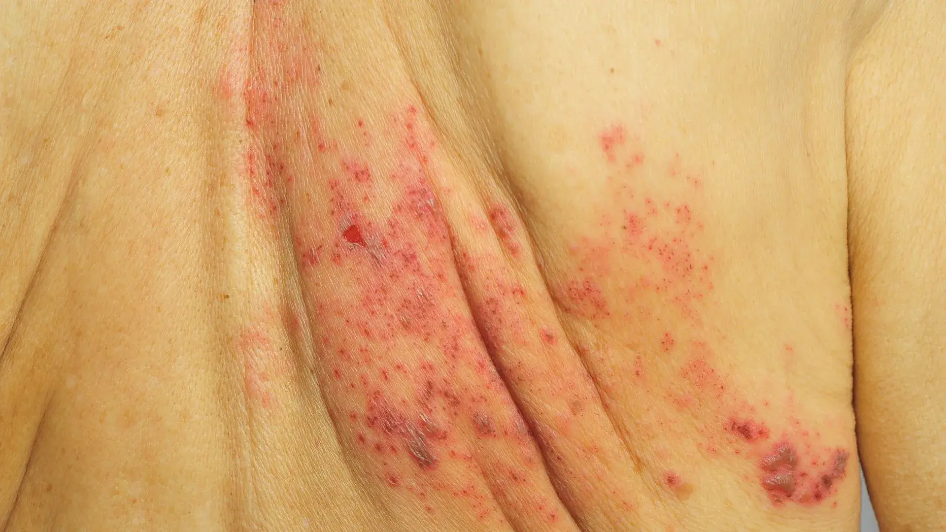 Shingles + Post-Herpetic Neuralgia