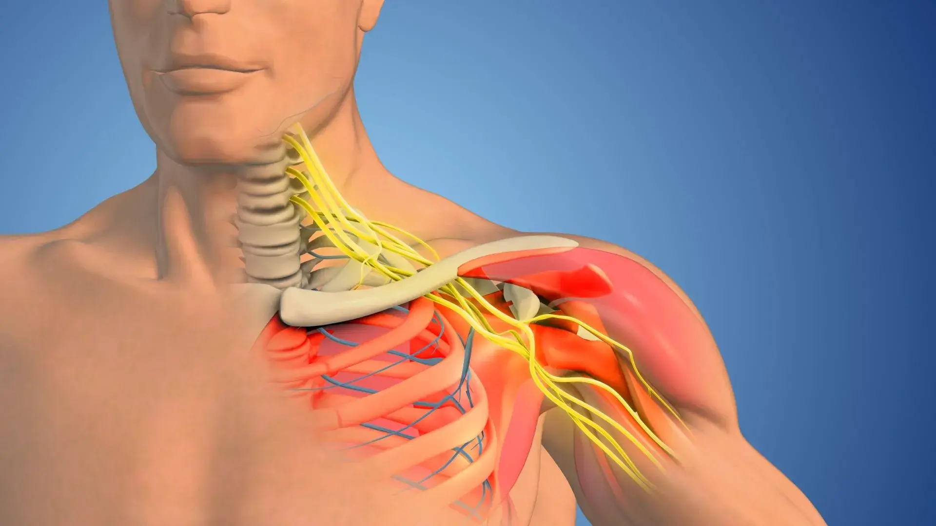 Thoracic Outlet Syndrome