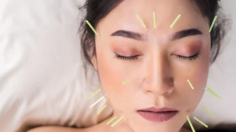 Cosmetic Acupuncture